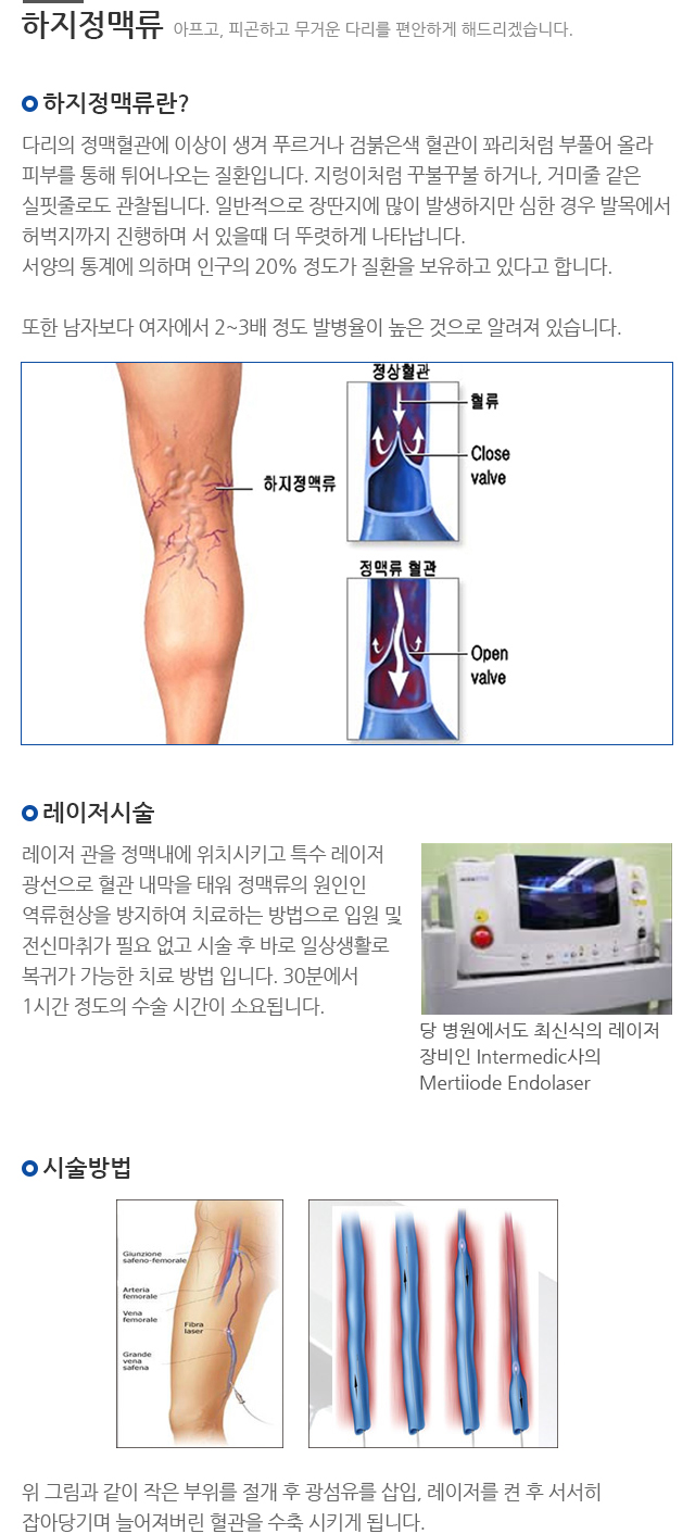 하지정맥류